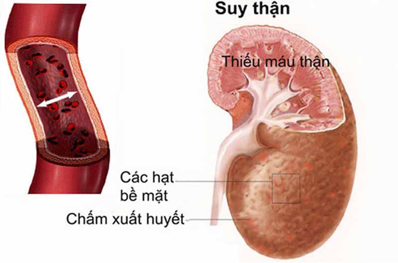 Không dùng thuốc cho những người bị suy thận nặng