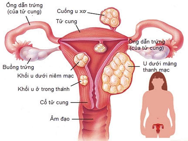 Bệnh viêm phần phụ theo khái niệm Đông y là gì?