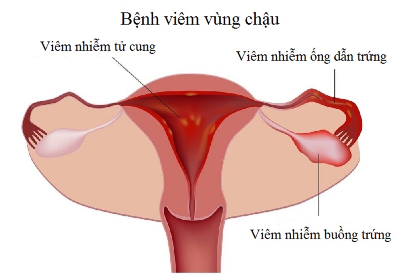 Viêm vùng chậu là bệnh gì?