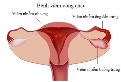 Viêm vùng chậu ở phụ nữ