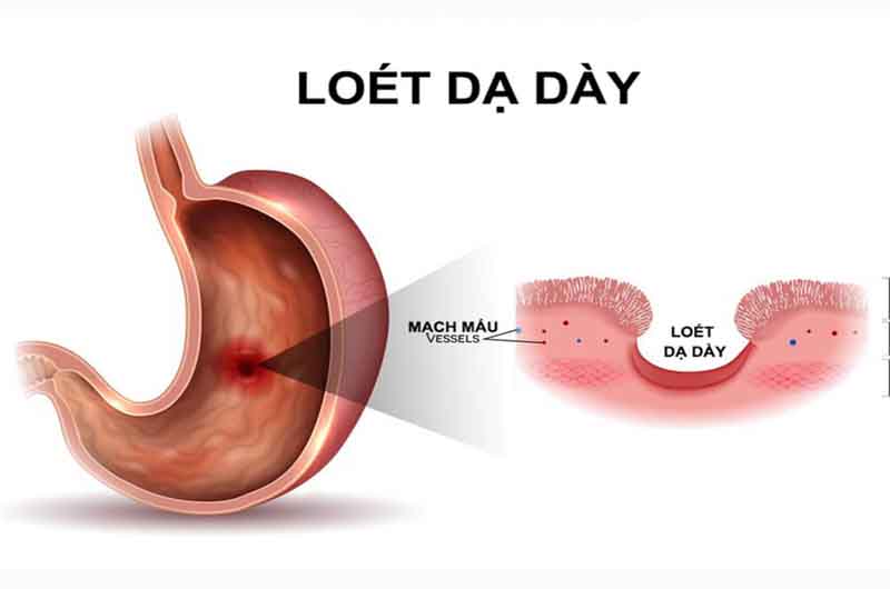 Acilesol là thuốc dùng để điều trị loét tá tràng, loét dạ dày lành tính