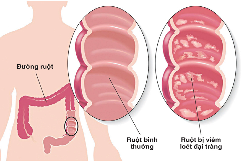 Balsalazide là thuốc điều trị viêm loét đại tràng hiệu quả