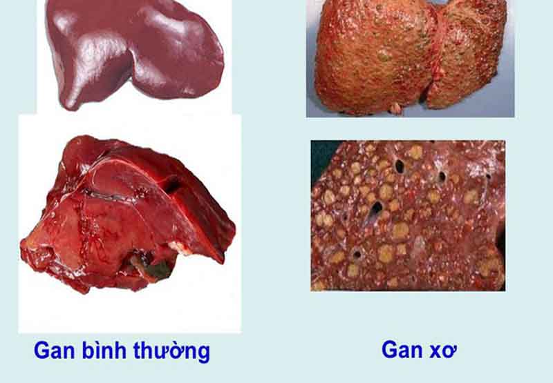 Hãy nói với bác sĩ nếu bạn bị xơ gan trước khi dùng thuốc