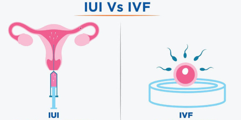 IVF đưa phôi vào tử cung còn IUI đưa tinh trùng vào buồng trứng