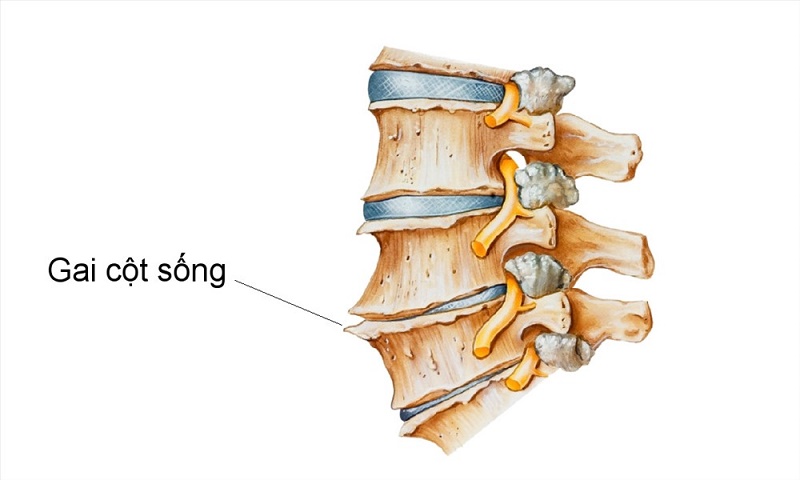 Bệnh gai cột sống