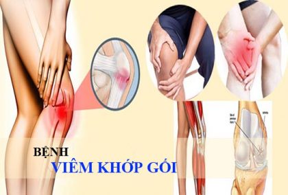 Bệnh viêm khớp gối