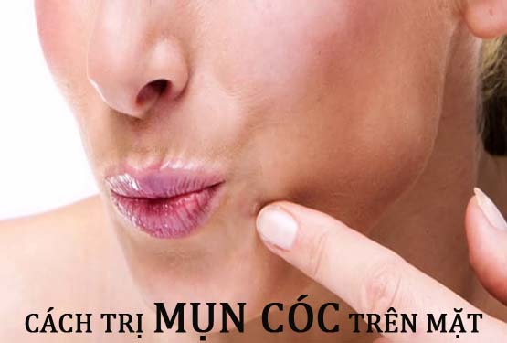 Cách trị mụn cóc trên mặt