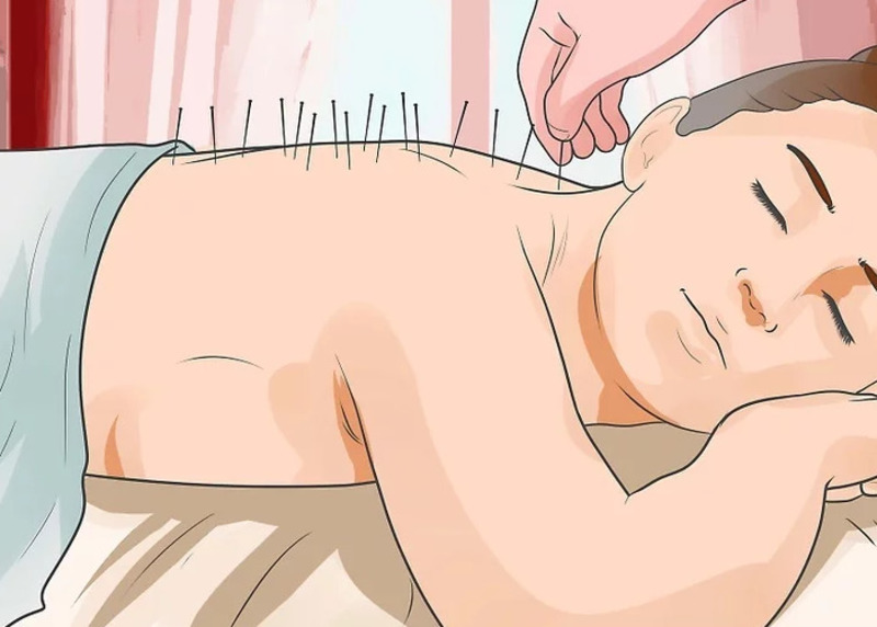 Châm cứu giúp cải thiện khả năng sinh sản Châm cứu giúp cải thiện khả năng sinh sản
