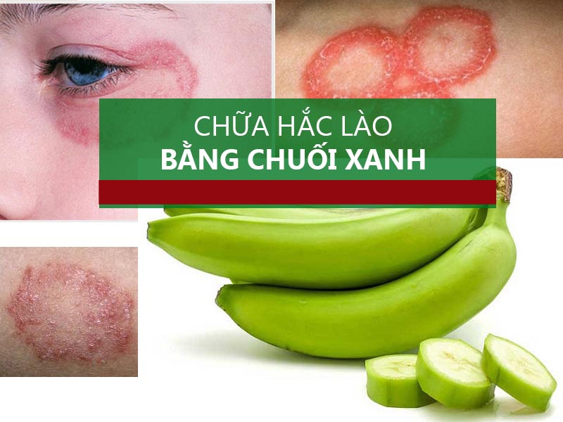 Chữa hắc lào bằng chuối xanh có thể cho hiệu quả tốt. an toàn