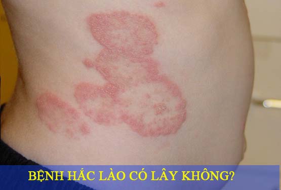 Hắc lào có lây không