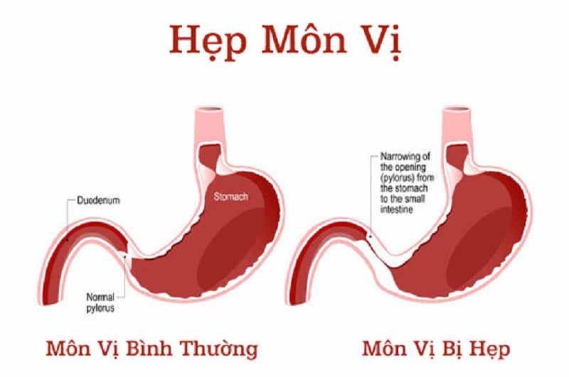 Hãy báo cho bác sĩ biết nếu bạn bị hẹp môn vị