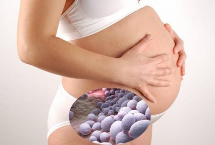 Nấm âm đạo khi mang thai