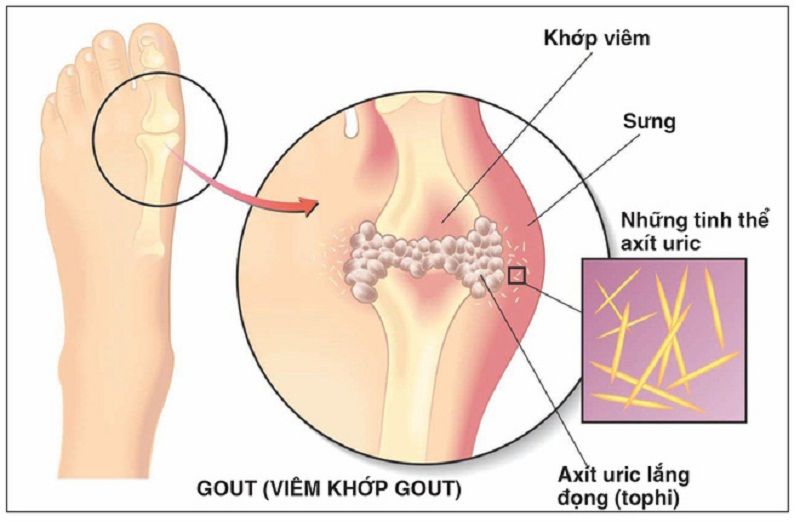 Ngón chân cái bị sưng nhức do bệnh gút