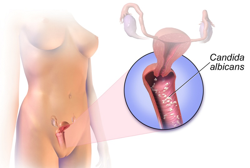 Nguyên nhân dẫn đến nấm Candida âm đạo là gì?