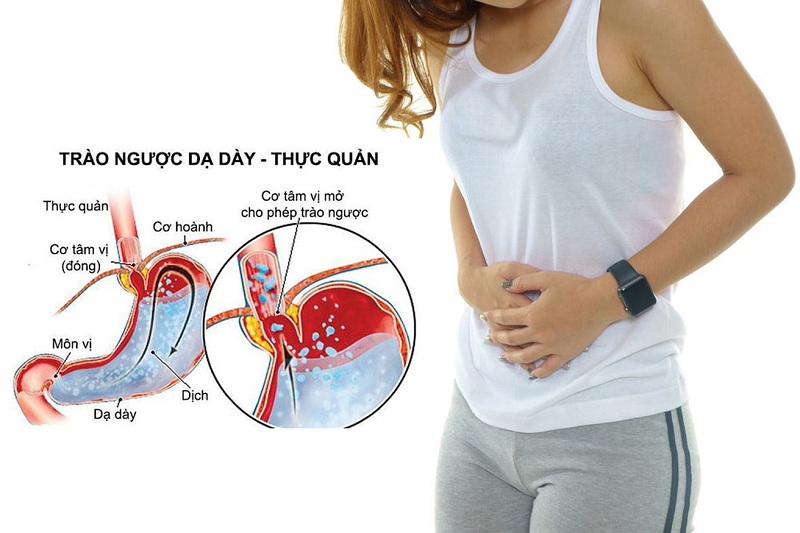 Những trường hợp bị trào ngược dạ dày liều dùng là 20mg, uống 1 lần/ngày