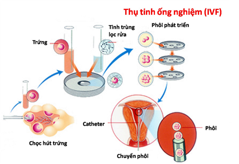 Thụ tinh trong ống nghiệm cũng được nhiều cặp vợ chồng áp dụng