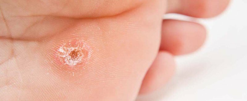 Sử dụng trái nhàu có thể chữa khỏi những nốt mụn do virus HPV gây ra.