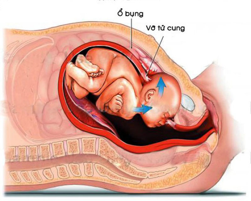 Vỡ tử cung là một tình trạng vô cùng nguy hiểm