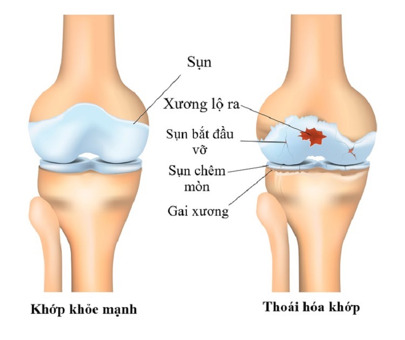 Bệnh gai khớp gối là gì?