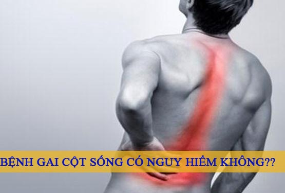 Bệnh gai cột sống có nguy hiểm không