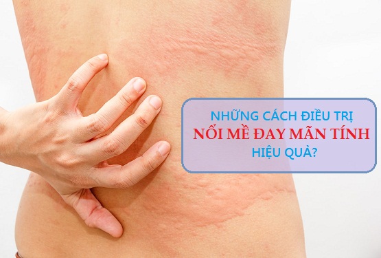 Cách điều trị mề đay mãn tính