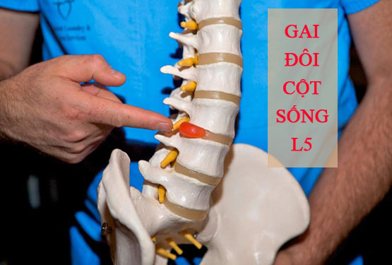 Gai đôi cột sống L5