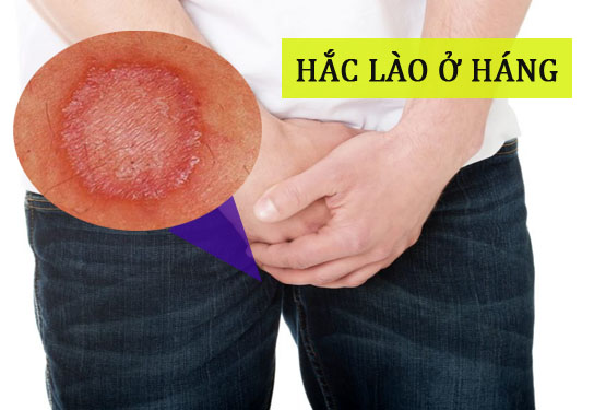 Hắc lào ở háng