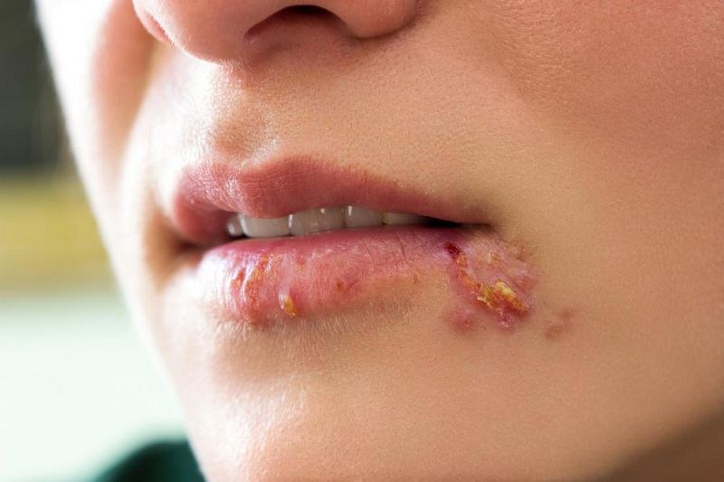 Liều dùng thuốc Famciclovir cho người nhiễm virus Herpes simplex môi