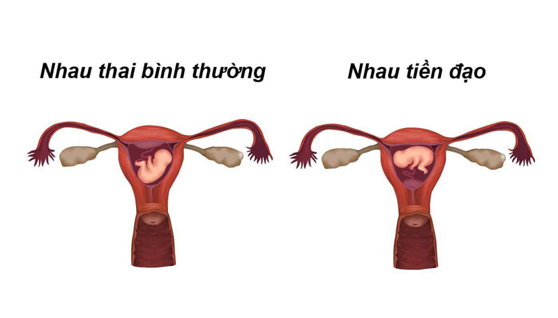 Nhau tiền đạo là tình trạng khá nguy hiểm ở mẹ bầu