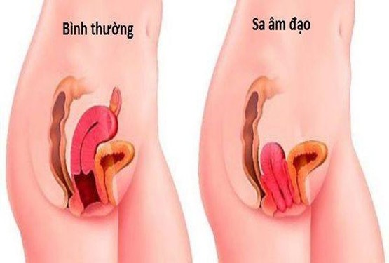 Tình trạng sa tử cung sau sinh