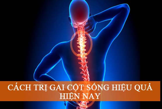 Trị gai cột sống