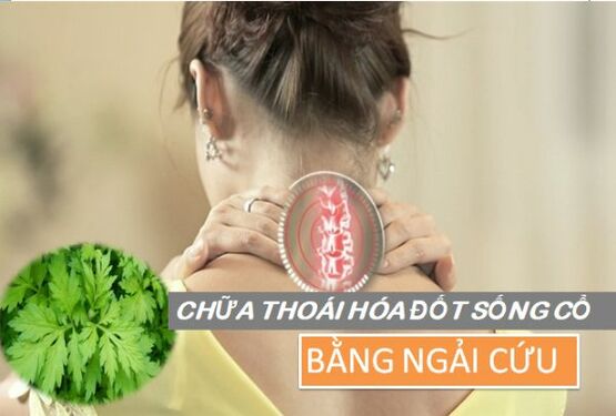 Chữa thoái hóa đốt sống cổ bằng ngải cứu