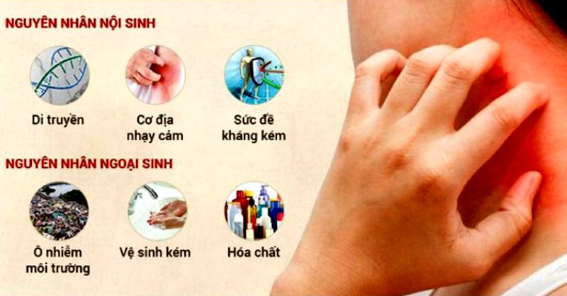 Có nhiều nguyên nhân dẫn tới bệnh