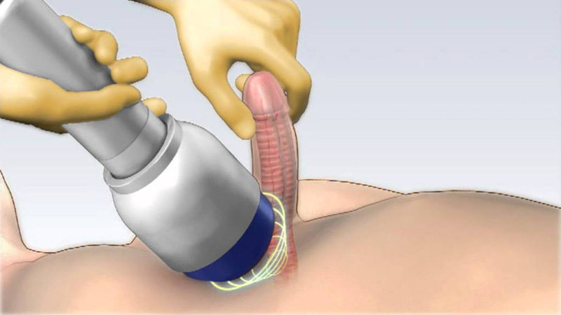 Chữa rối loạn cương dương bằng sóng xung kích có hiệu quả không?