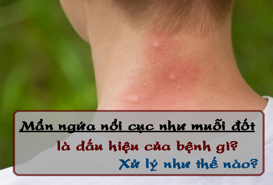 Mẩn ngứa nổi cục như muỗi đốt