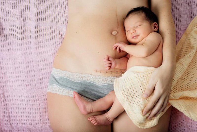 Sinh mổ không nên dùng đai massage bụng quá sớm Cách sử dụng đai massage giảm mỡ bụng bụng sau sinh