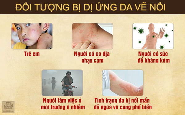 Đối tượng dễ bị dị ứng da vẽ nổi