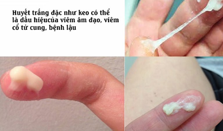 Khí hư bệnh lý