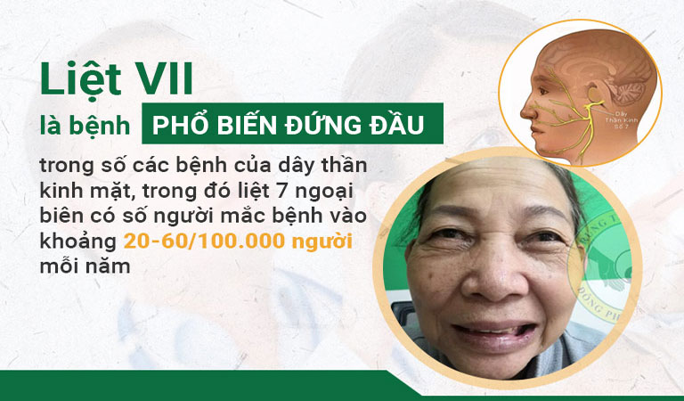 Liệt VII là căn bệnh phổ biến đứng đầu về các bệnh của dây thần kinh mặt