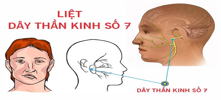 Liệt dây thần kinh số 7 gây méo miệng, liệt mặt