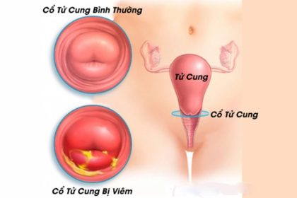 Bệnh viêm cổ tử cung ngày càng có nhiều người mắc