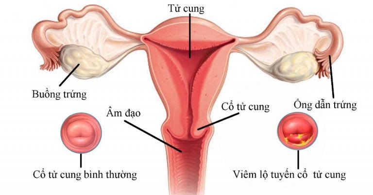 Hình ảnh viêm lộ tuyến cổ tử cung