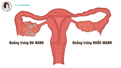 Buồng trứng đa nang tiếng Anh là gì? - Polycystic Ovarian Syndrome (PCOS)