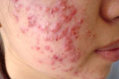 Cách trị mụn mủ