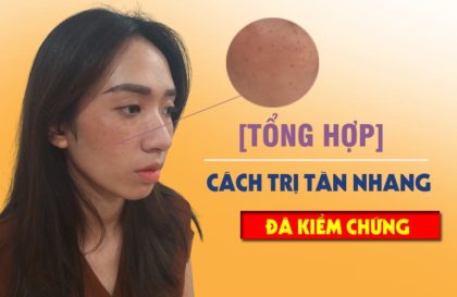 Cách trị tàn nhang