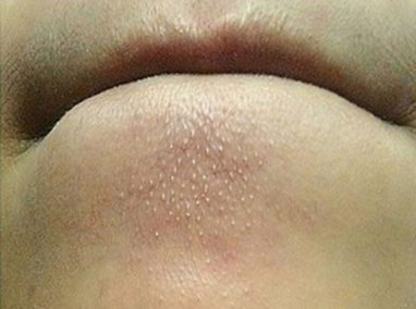 Cách trị mụn cám