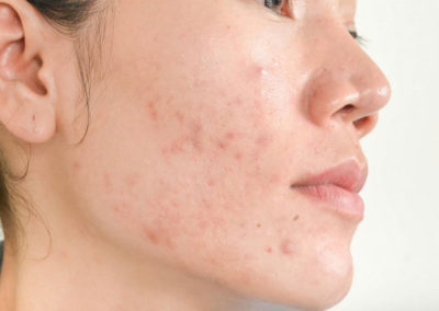 Trị mụn thâm hiệu quả