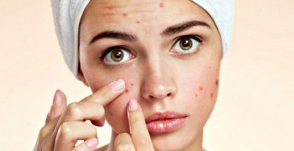 Trị mụn trứng cá tại nhà