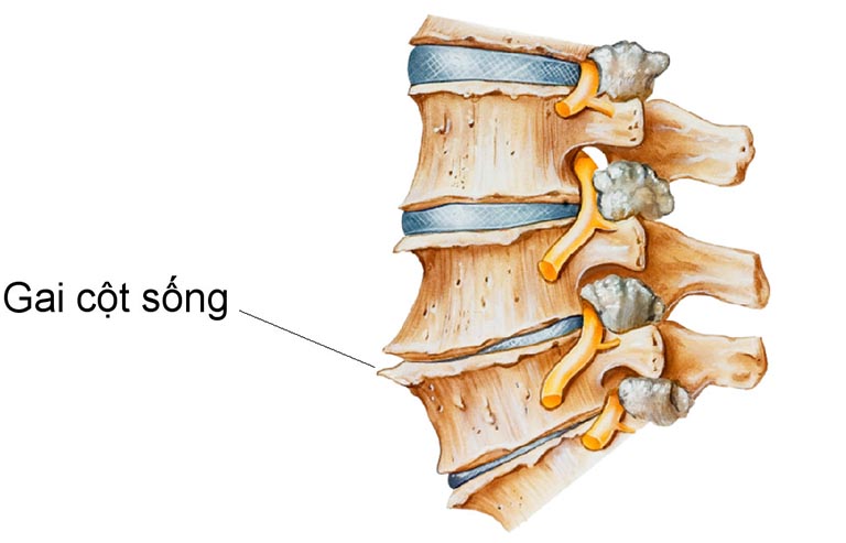 Bệnh gai cột sống là gì?