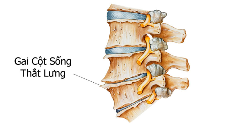 gai cột sống thắt lưng